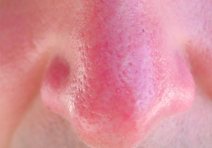 Mũi đỏ là bệnh gì và cách chữa như nào tốt nhất?