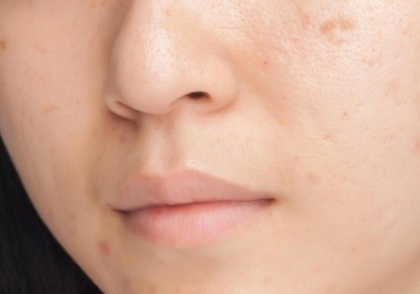 Cách chăm sóc da mặt tốt nhất sau khi nặn mụn đúng cách là đây!