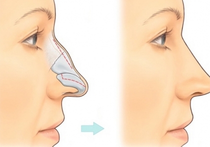 Gãy sụn mũi nên khắc phục như thế nào là an toàn nhất?
