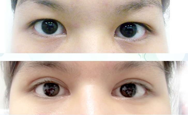 Phẫu thuật mở rộng góc mắt tạo mắt to tròn đẹp long lanh